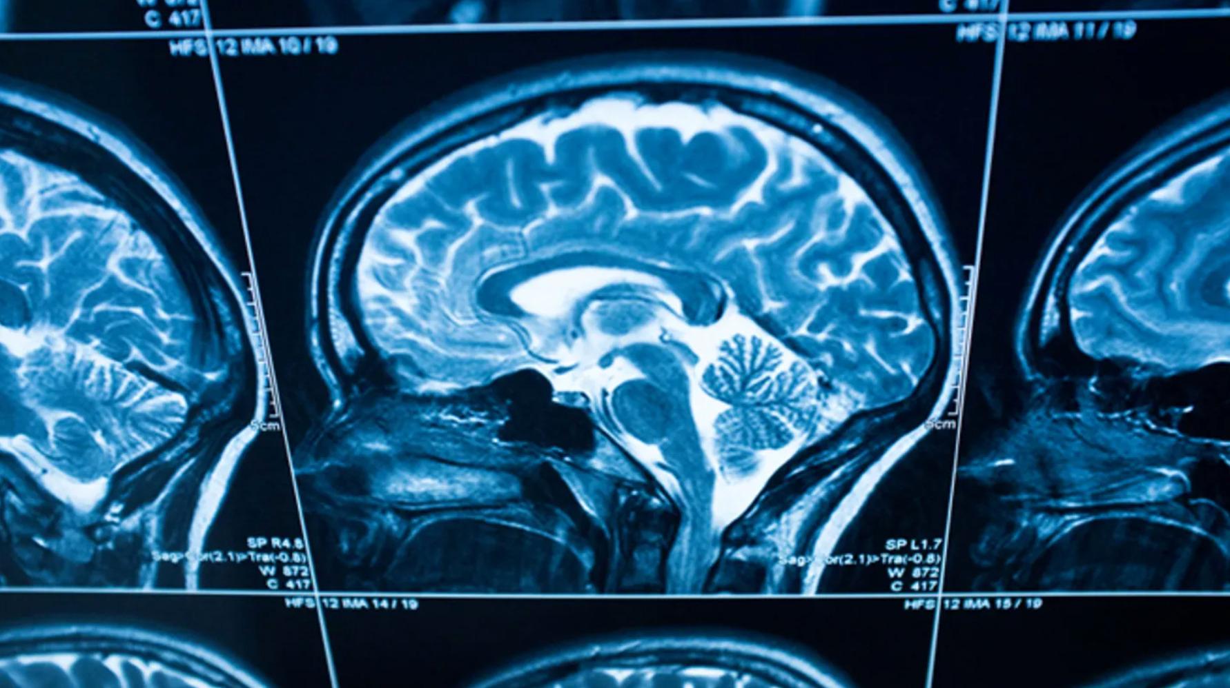 Personalization of Major Depression Disorder treatment using heterogeneity of depression